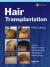 Hair Transplantation Encyclopedia Article